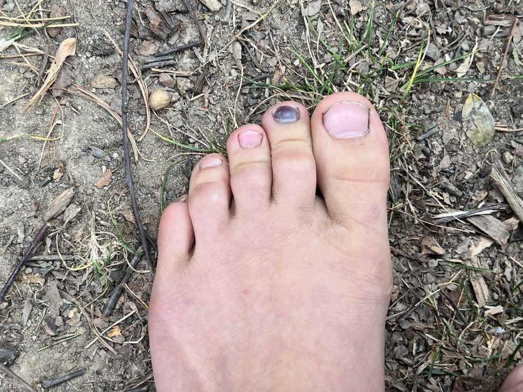 bruised toenail