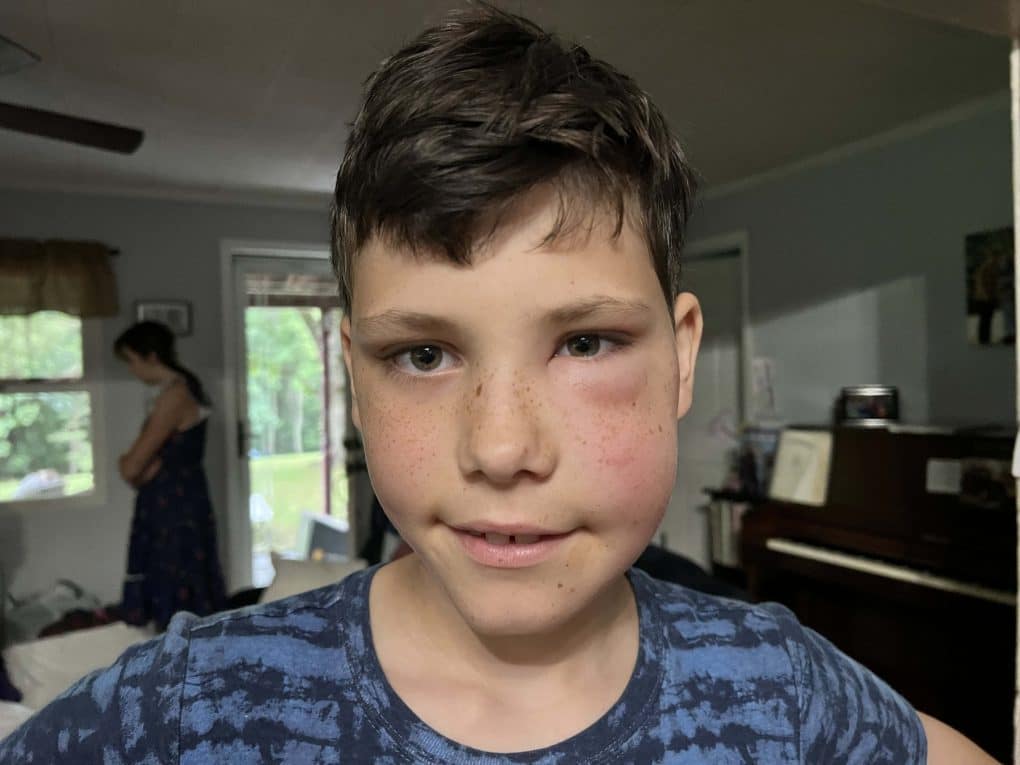boy stung by a bee on his face