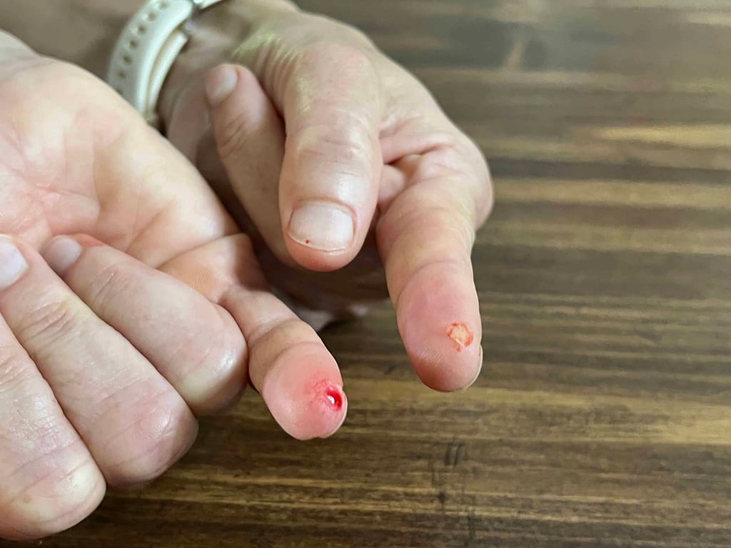 pinky finger with a tiny chunk of skin sliced off