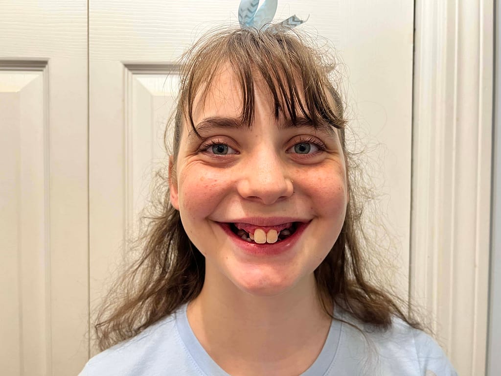 teen after teeth pulled