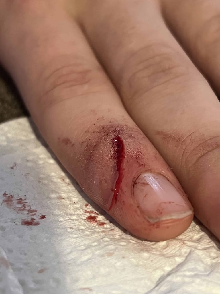 a deep cut on a finger