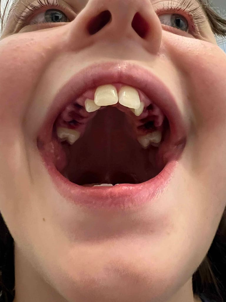 teen mouth with 6 teeth missing