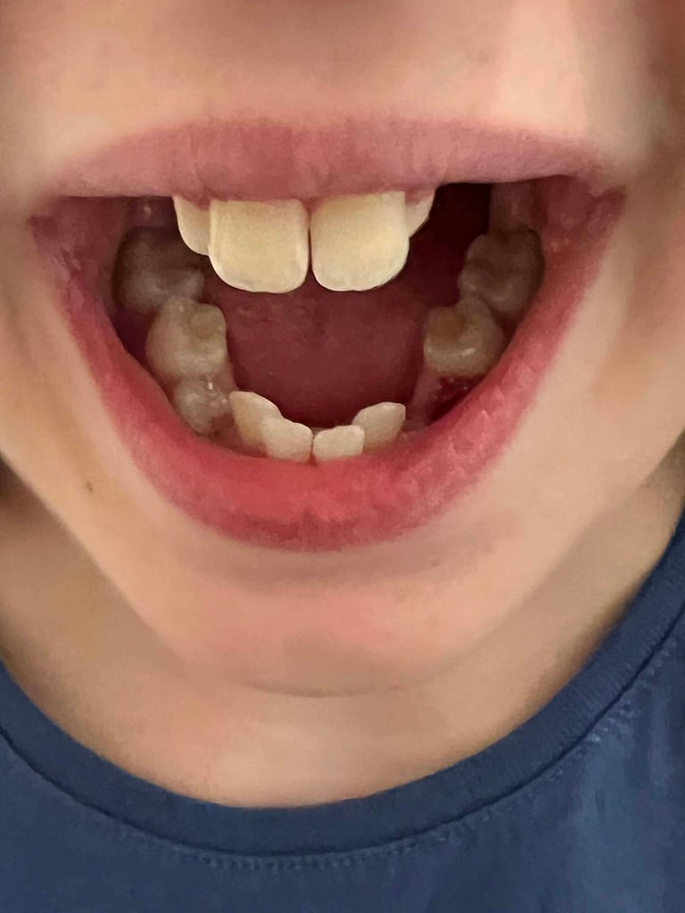 mouth after 2 teeth were pulled