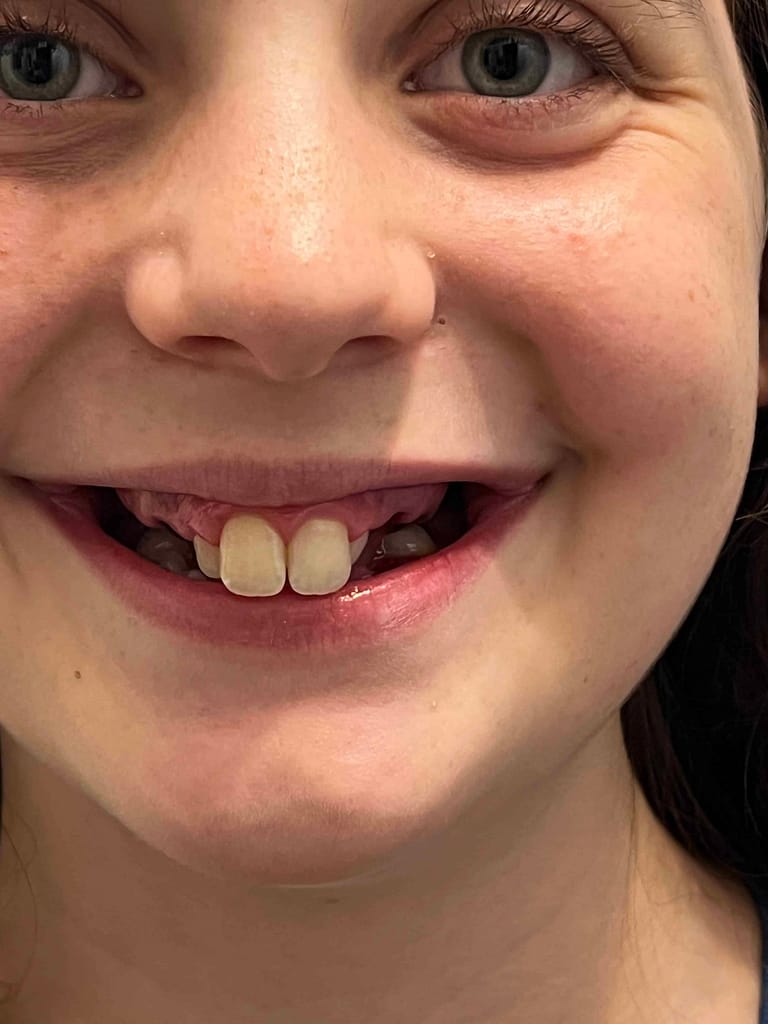 mouth after 8 teeth were pulled