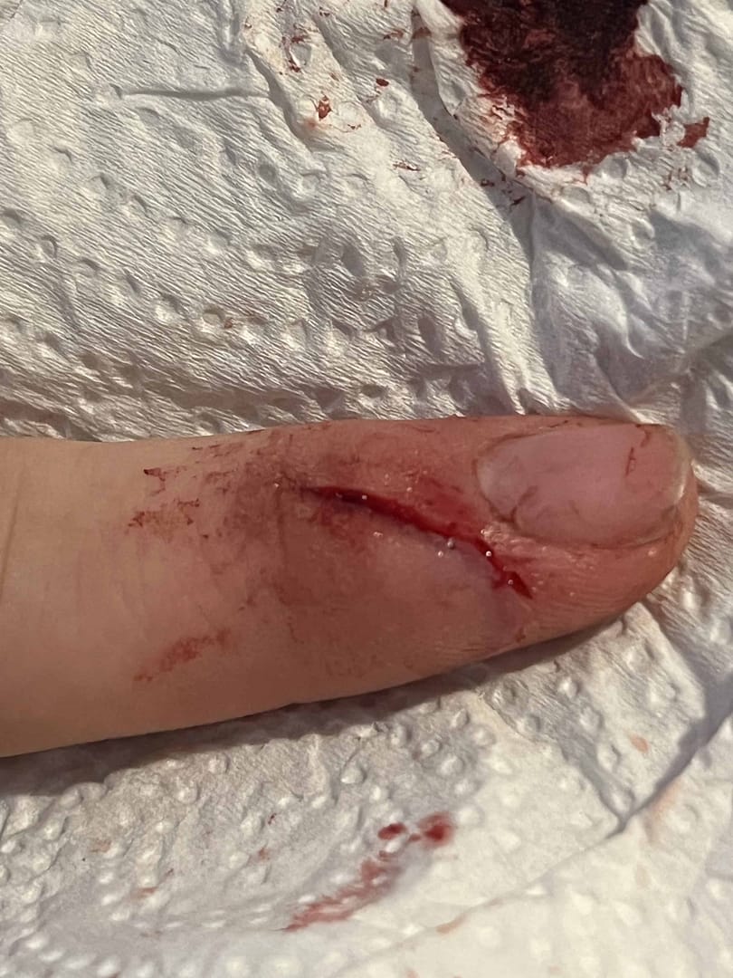 finger with a bad cut