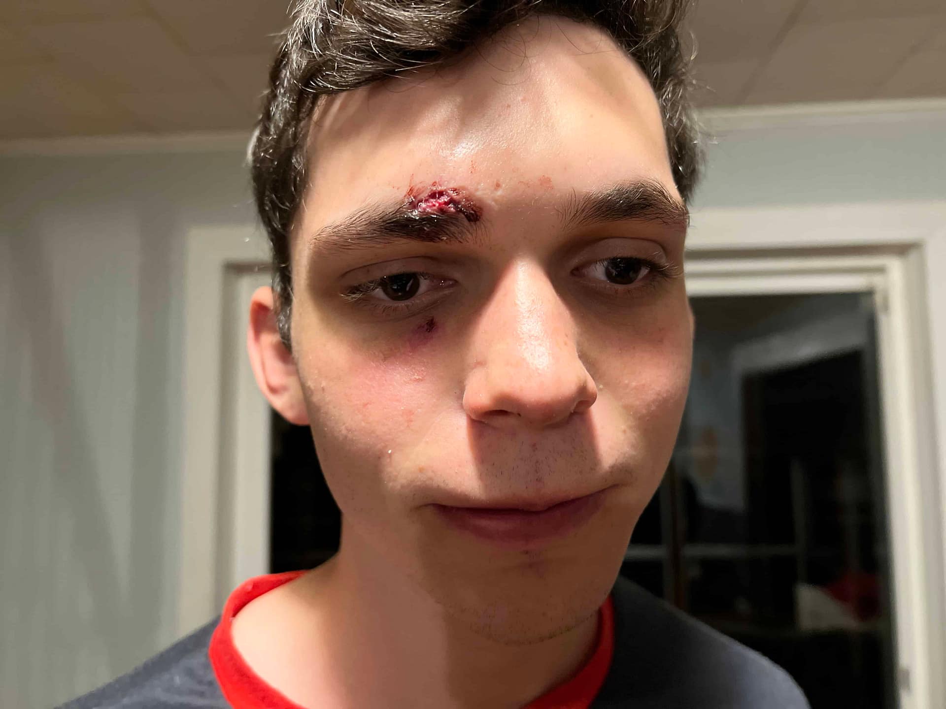 boy with cut over his eyebrow